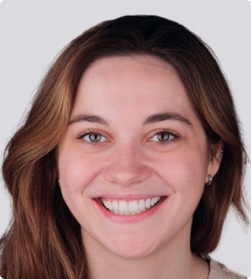 Виниры за 5 визитов